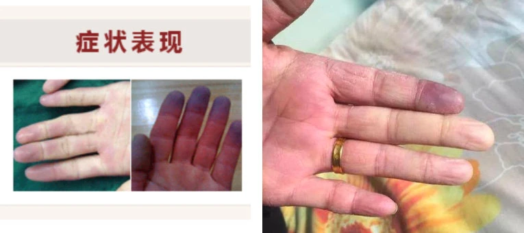 雷諾氏病